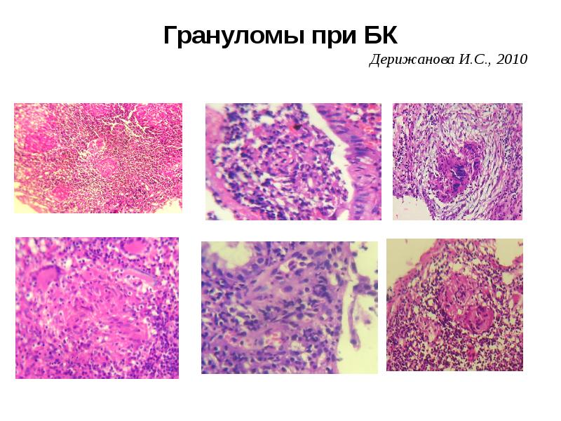 Трубная беременность микропрепарат рисунок