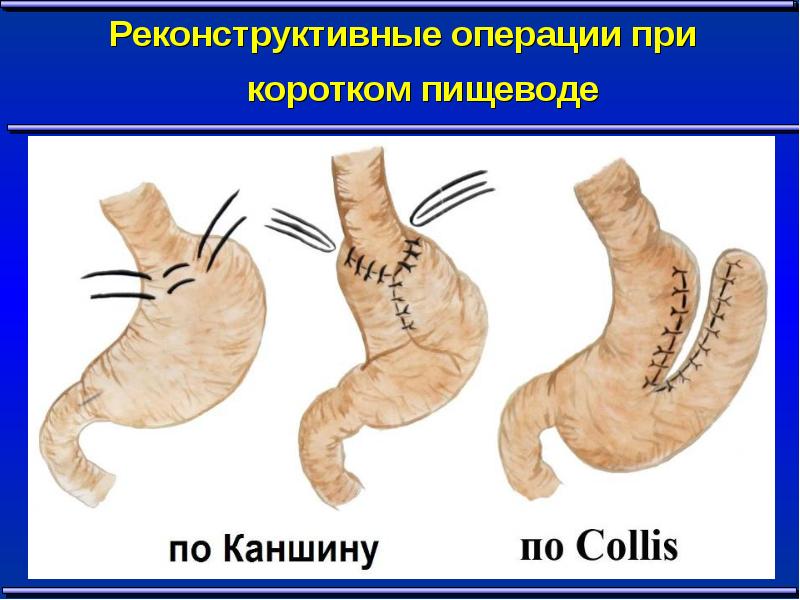 Заболевания диафрагмы госпитальная хирургия презентация