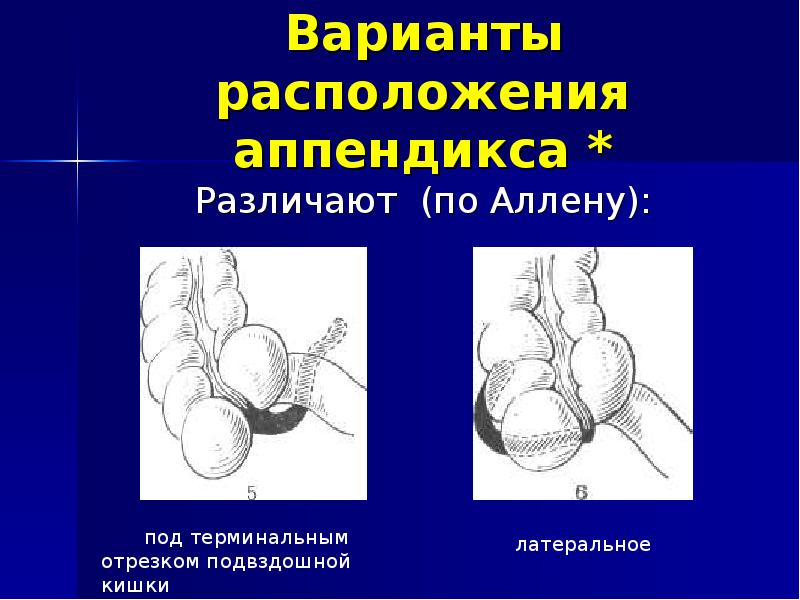 Особенности клинической картины острого аппендицита при тазовом расположении червеобразного отростка