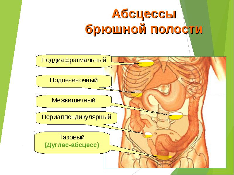 Абсцесс брюшной полости презентация