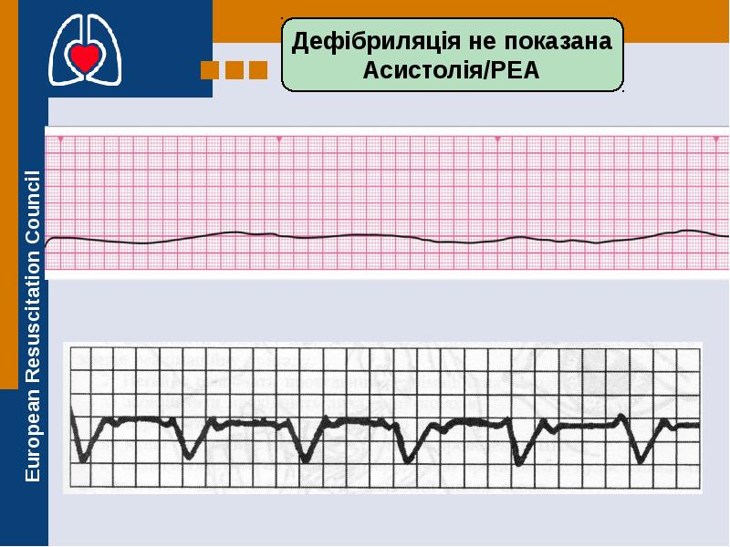 Дефибрилляция при асистолии