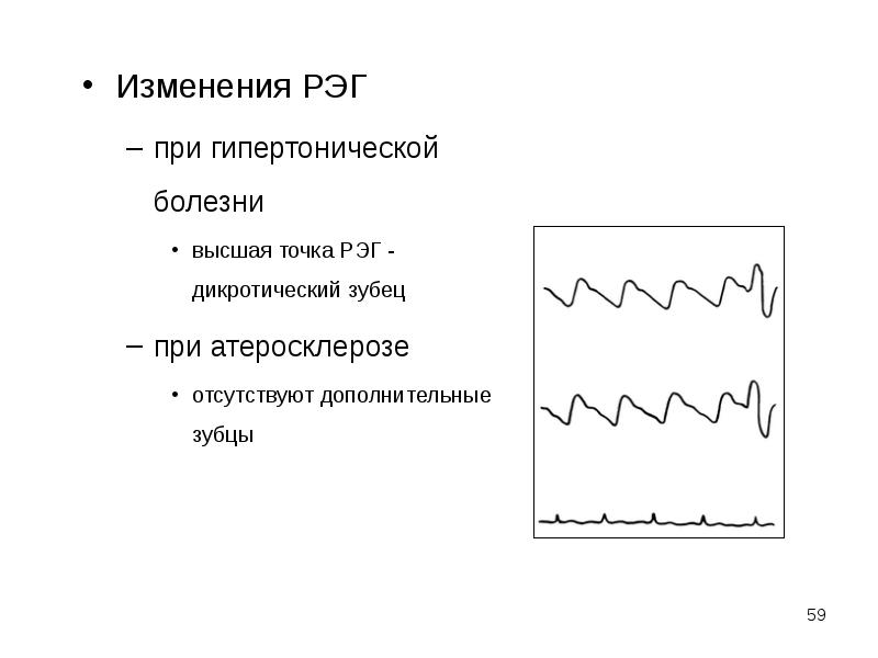 Реоэнцефалография интерпретация результатов. Типы рэг атонический. Гипертонический тип рэг схема. Гипертонический тип рэг. Гипертонический тип рэг.