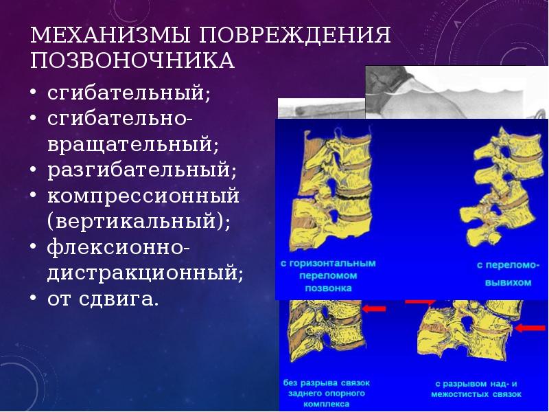 Презентация на тему травма позвоночника спины