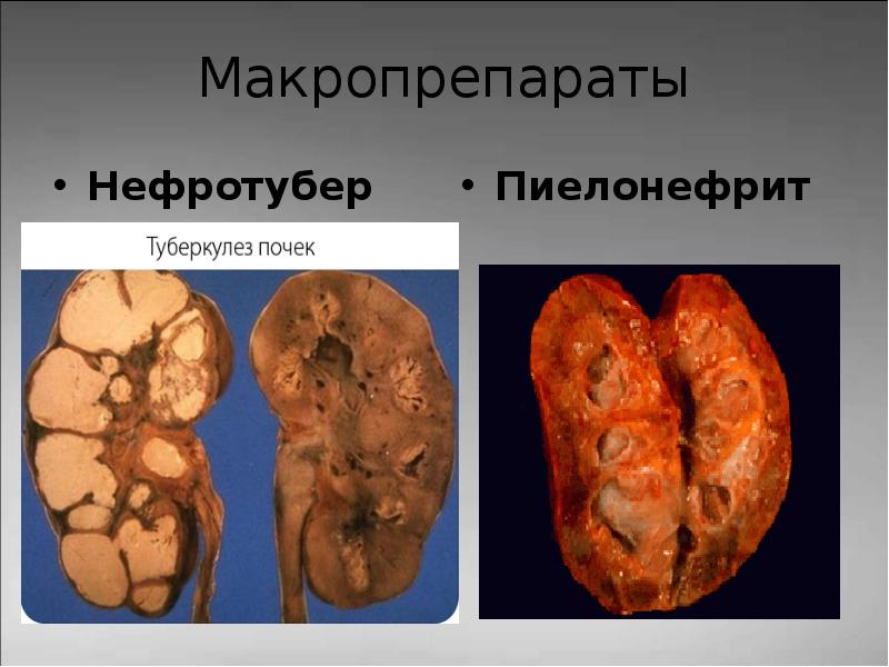 Презентация туберкулез мочевыделительной системы