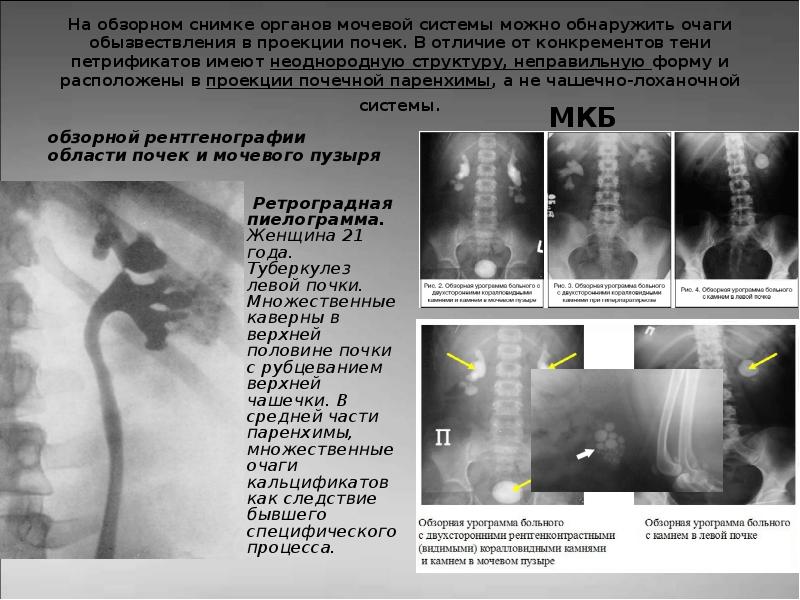 Презентация туберкулез мочевыделительной системы