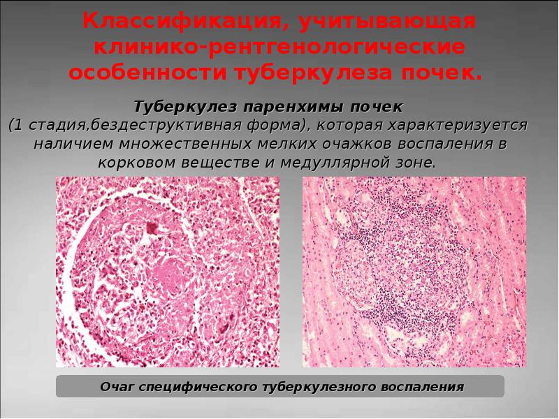 Туберкулез мочевыделительной системы презентация