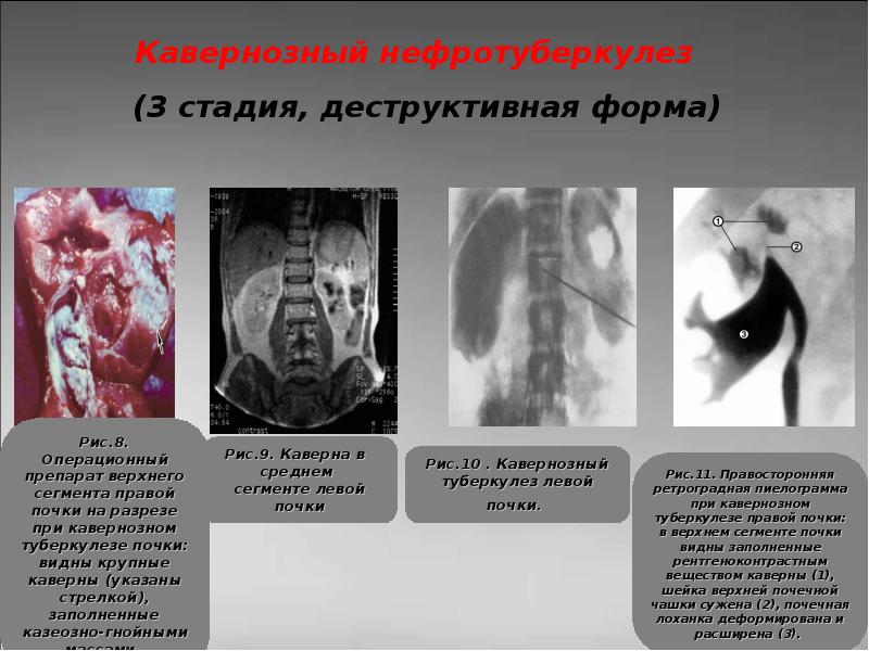 Презентация туберкулез мочевыделительной системы