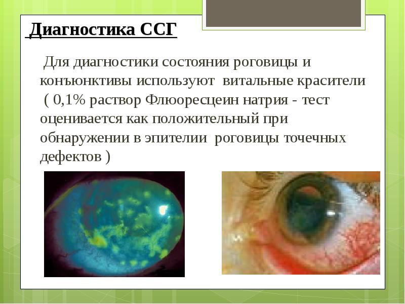 Презентации по синдрому сухого глаза
