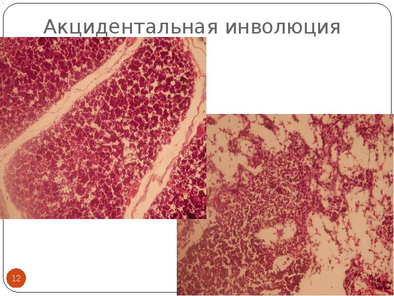 Инволюция железы. Акцидентальная инволюция тимуса. Акцидентальная трансформация тимуса микропрепарат патанатомия. Акцидентальная инволюция тимуса гистология. Акцидентальная инволюция тимуса патанатомия.