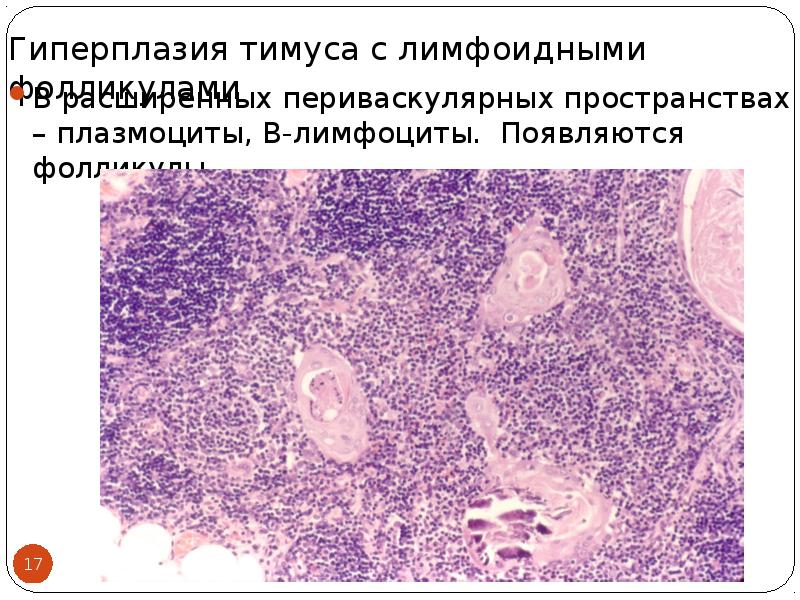 Периваскулярные пространства. Периваскулярного пространство тимуса. Периваскулярное пространство в тимусе гистология. Периваскулярная ткань. Гиперплазия лимфоидных клеток селезенки.