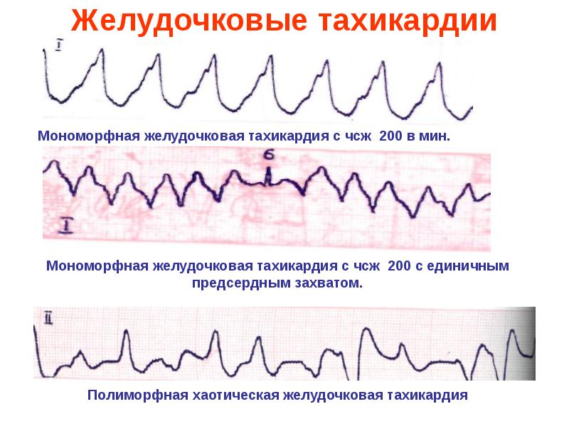 Фибрилляция желудочков карта вызова