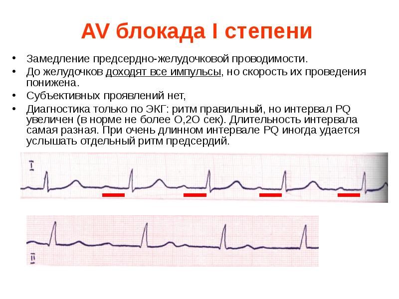 Расшифровка экг презентация