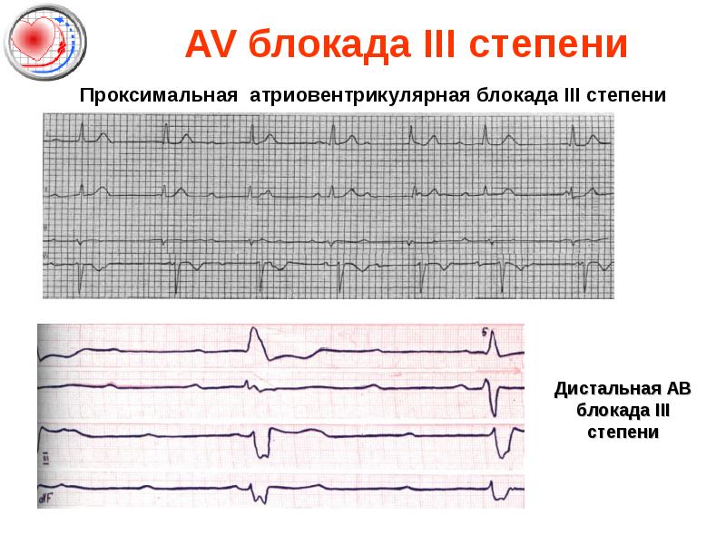 Схема анализа экг