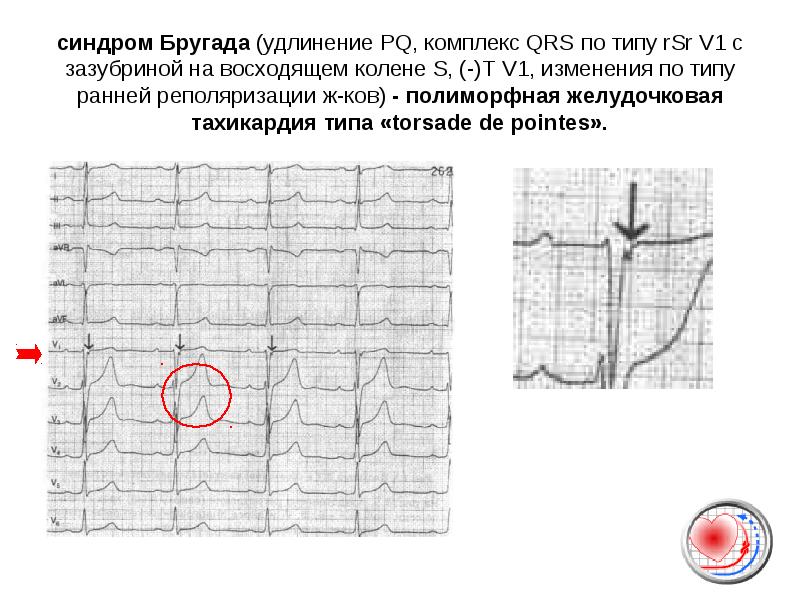 Доклад: Синдром Бругада