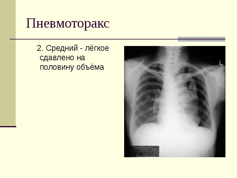 Пневмоторакс легких