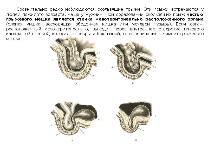 Скользящая грыжа. Этиология скользящей грыжи. Скользящая грыжа мочевого пузыря. Скользящая пупочная грыжа. Скользящая грыжа грыжевого мешка.