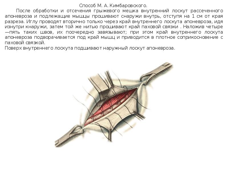 Пластика пахового канала по кимбаровскому