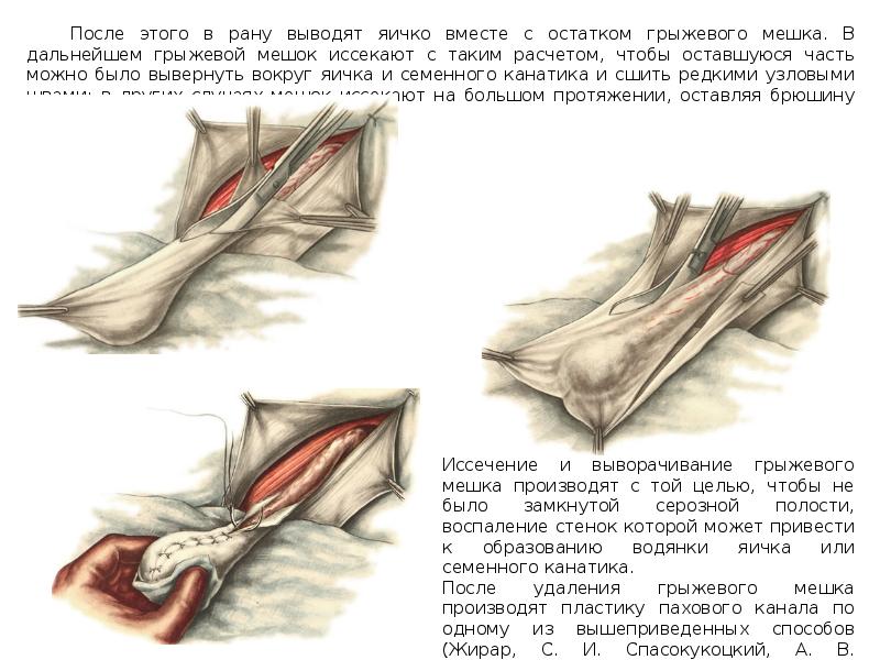 Пластика пахового канала по мартынову