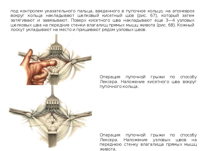 Пупочное кольцо. Кисетный шов вокруг пупочного кольца. Способ Лексера при пупочных грыжах. Кисетный шов куда накладывают.