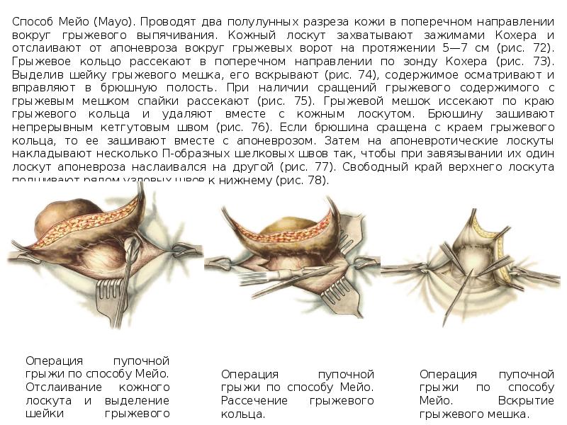 Пластика пупочной грыжи. Пупочная грыжа операция по Мейо. Операция при пупочной грыже по Мейо. Пластика пупочной грыжи по Мейо.