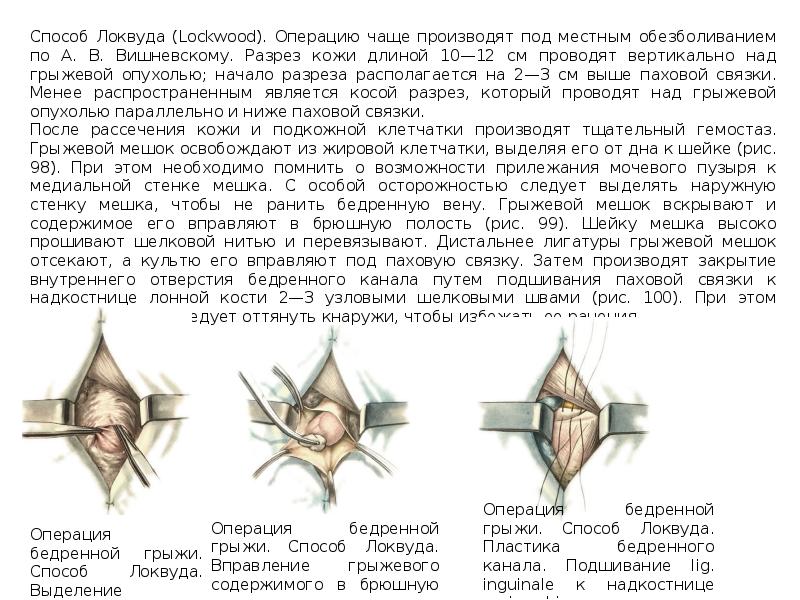 Бедренный способ. Способ Локвуда Бассини. Метод Бассини при бедренной грыже. Операция Бассини при бедренных грыжах.