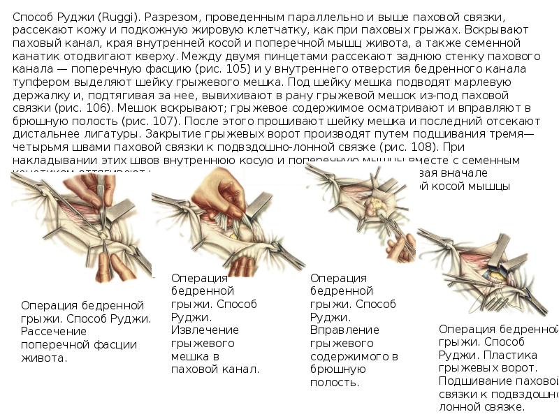 Бедренный способ при бедренной грыже. Операции при бедренных грыжах. Пластика бедренной грыжи.