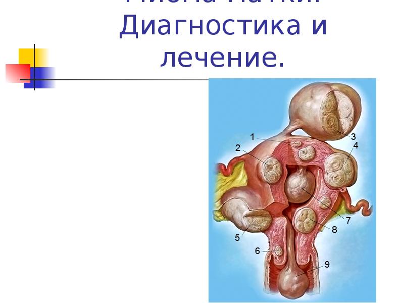 Миоматозный узел рождающийся фото