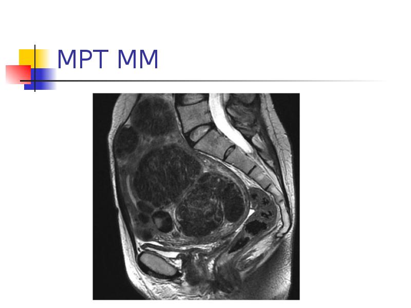 Миома матки мрт картина