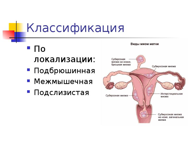 Презентация по гинекологии миома матки