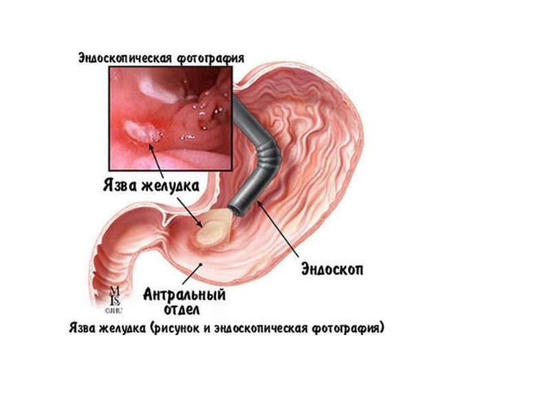 Язвенная болезнь двенадцатиперстной кишки картинки