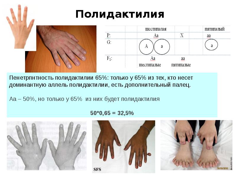 полидактилия генная мутация. полидактилия наследственное заболевание. полидактилия задачи. полидактилия какой ген. полидактилия какой ген.