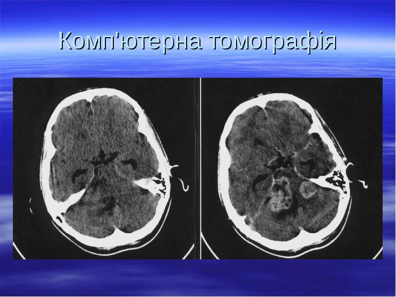Комп'ютерна томографія Комп'ютерна томографія