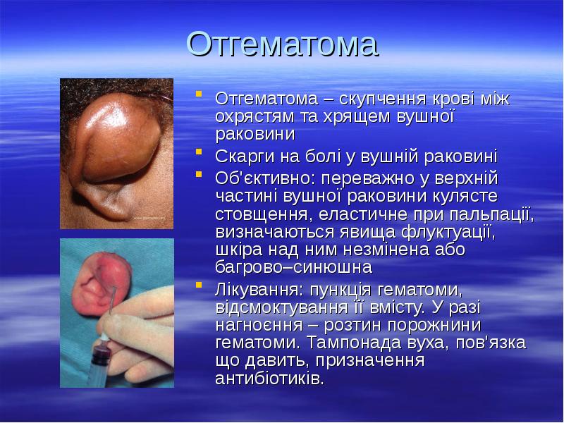 Отгематома
Отгематома – скупчення крові між охрястям та хрящем вушної Отгематома
Отгематома – скупчення крові між охрястям та хрящем вушної