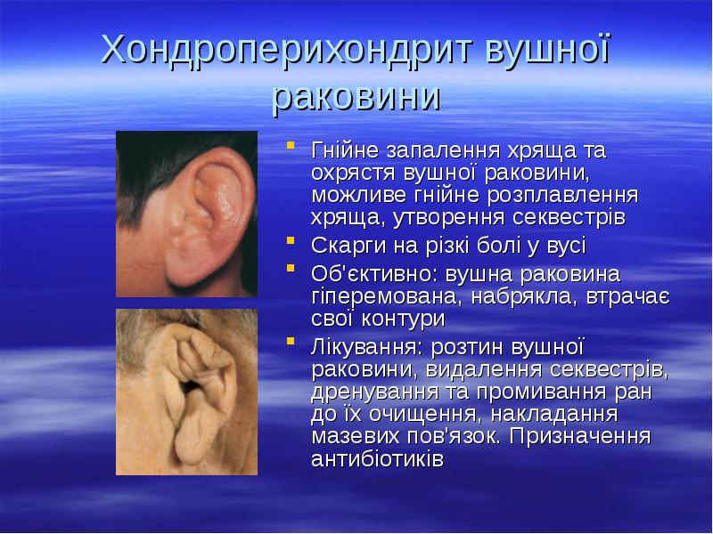Хондроперихондрит вушної раковини
Гнійне запалення хряща та охрястя вушної раковини, можливе Хондроперихондрит вушної раковини
Гнійне запалення хряща та охрястя вушної раковини, можливе