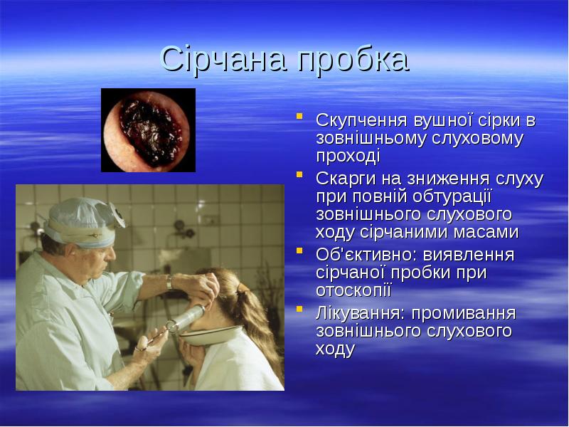Сірчана пробка
Скупчення вушної сірки в зовнішньому слуховому проході
Скарги на Сірчана пробка
Скупчення вушної сірки в зовнішньому слуховому проході
Скарги на