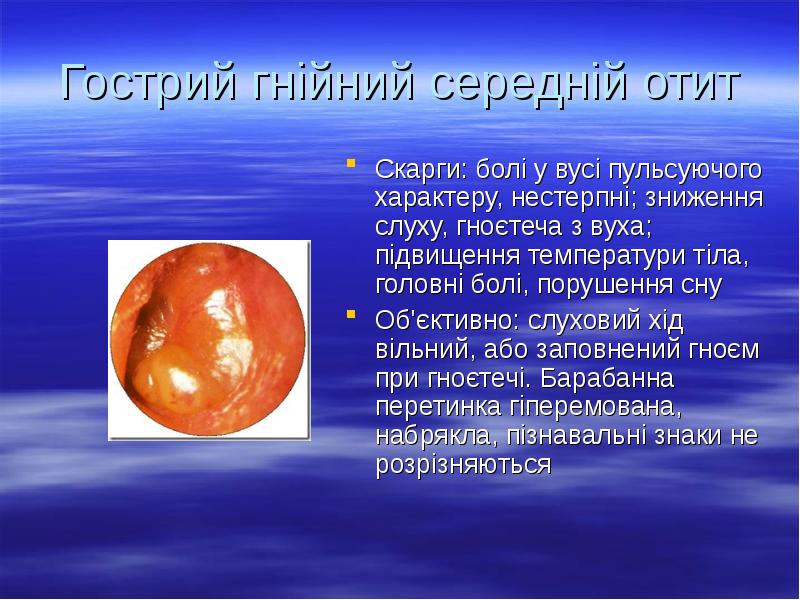 Гострий гнійний середній отит
Скарги: болі у вусі пульсуючого характеру, нестерпні; Гострий гнійний середній отит
Скарги: болі у вусі пульсуючого характеру, нестерпні;