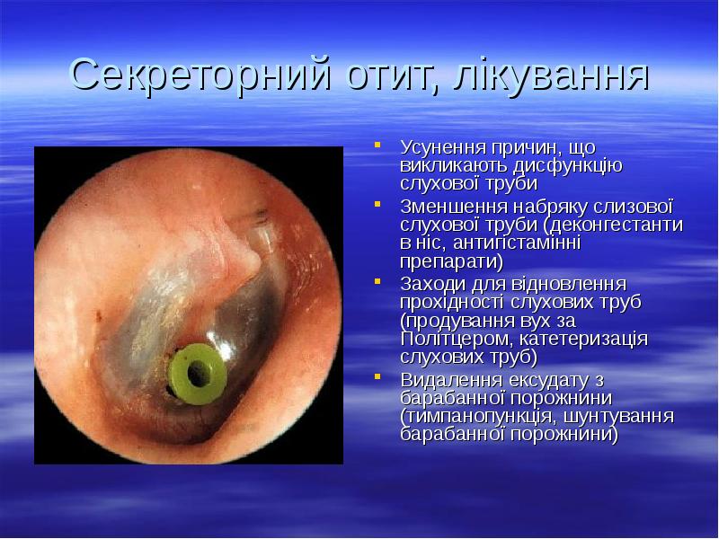 Секреторний отит, лікування
Усунення причин, що викликають дисфункцію слухової труби
Зменшення Секреторний отит, лікування
Усунення причин, що викликають дисфункцію слухової труби
Зменшення