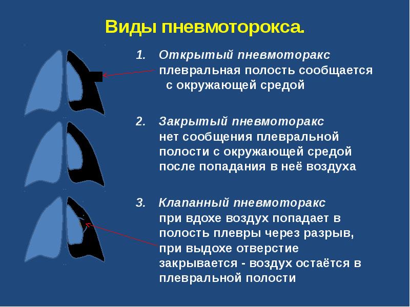 Клапанный пневмоторакс презентация