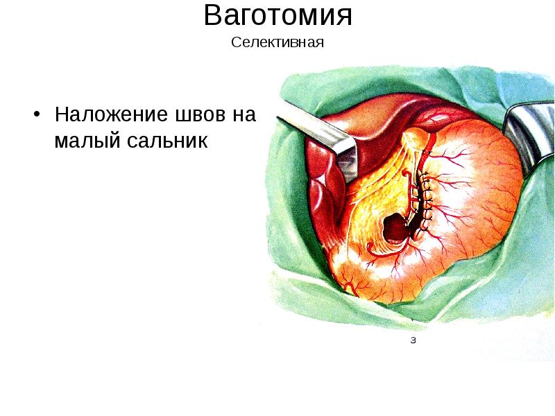 Шов после операции на желудке фото