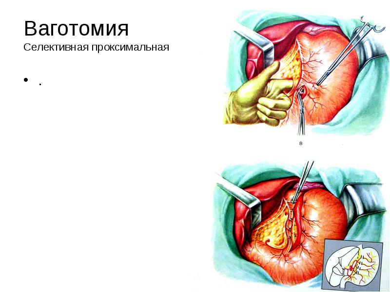 Операция фрея на поджелудочной железе схема