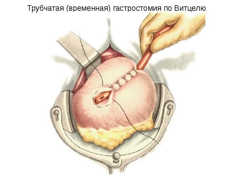 Виды гастростомии