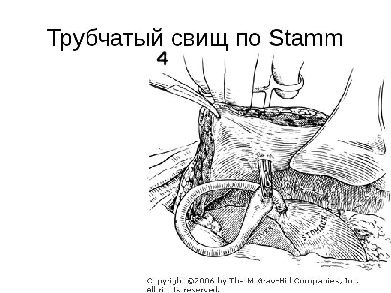 Свищи хирургия презентация