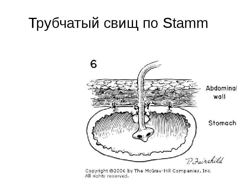 Губовидные и трубчатые свищи