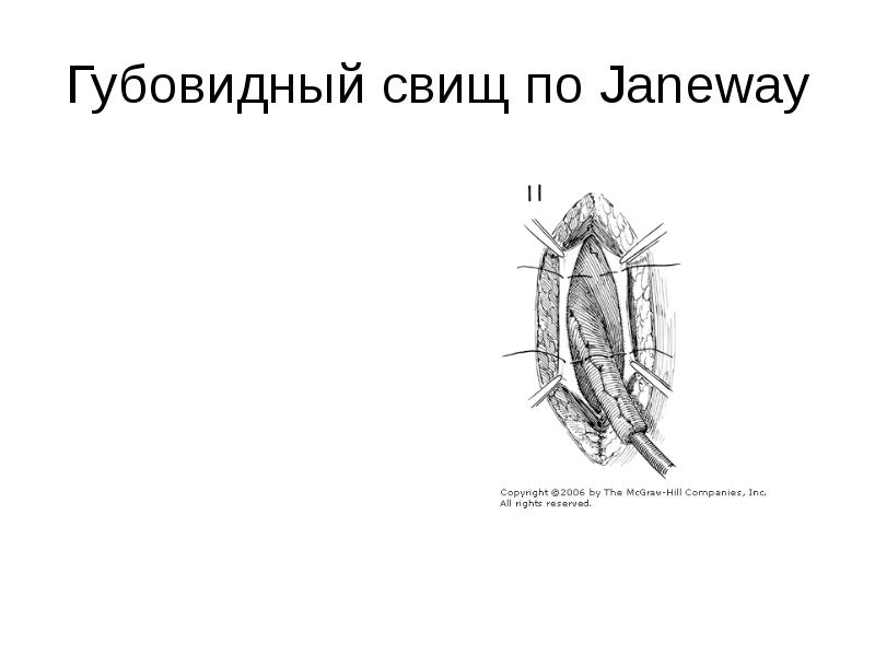 Свищи хирургия презентация