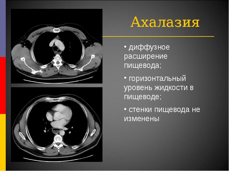 Жүйелі склеродермия презентация