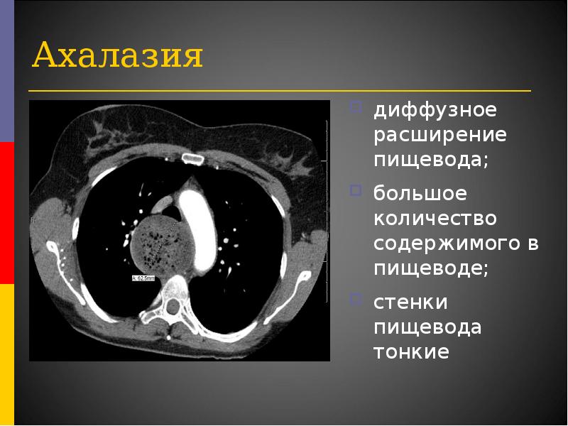 Расширение стенок пищевода