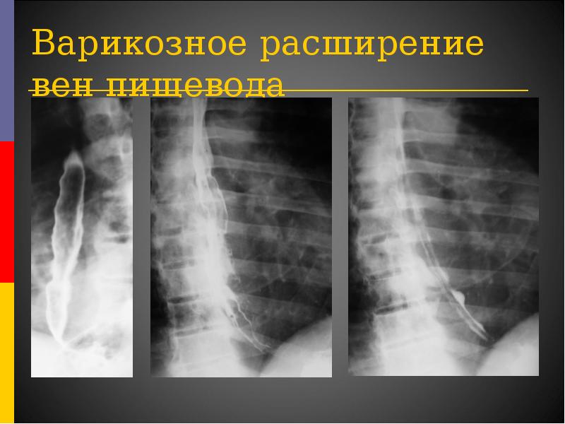 Ахалазия кардии презентация