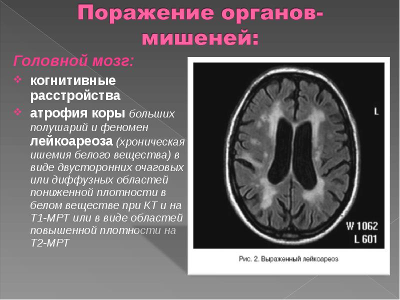 Очаги ишемии головного мозга. Рассеянный склероз лейкоареоз. Лейкоареоз головного на кт. Перивентрикулярный лейкоареоз на кт. Лейкоареоз головного мозга на кт.