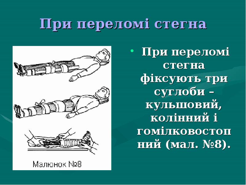 Презентація на тему перша допомога при переломах