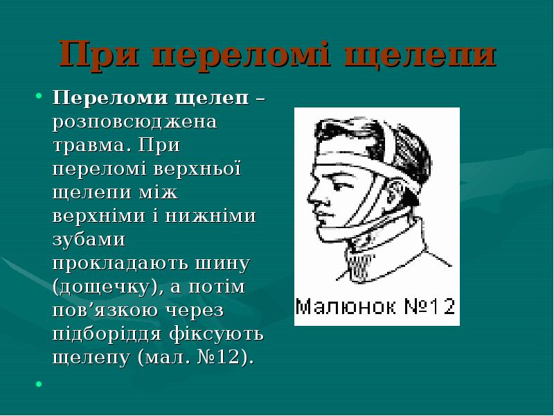 Презентація на тему перша допомога при переломах